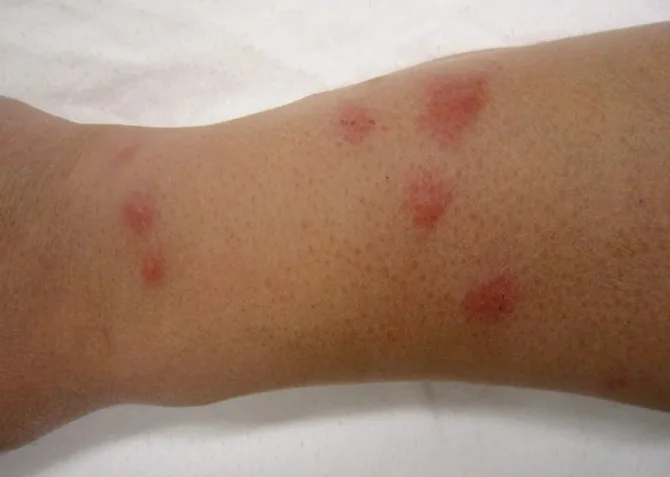 bed-bug-bites-on-arm