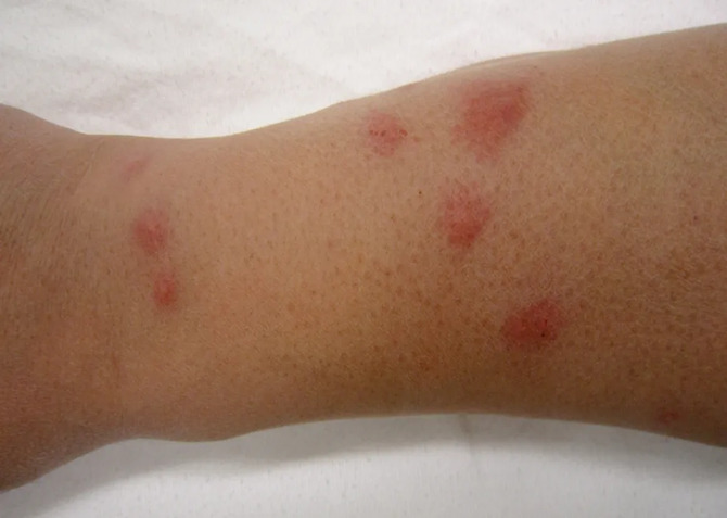 bed-bug-bites-on-arm