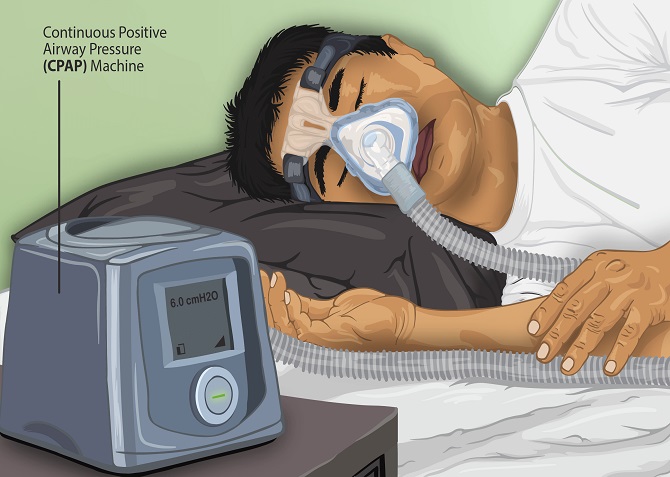 cpap machine sleep apnea